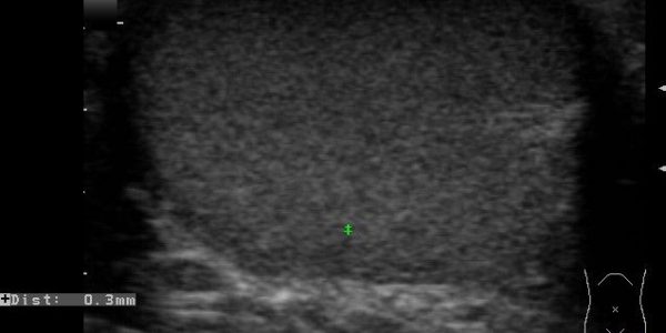 精巣内精子回収卵ｪ超音波画像